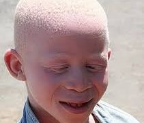 « ANAT » pour célébrer une décennie de progrès en faveur des personnes atteintes d’albinisme au Togo